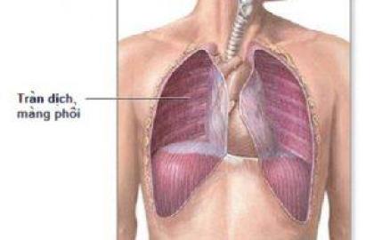 Cách hỗ trợ điều trị tràn dịch màng phổi bằng đông y hiệu quả